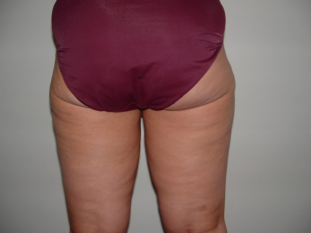 cellulite body toning