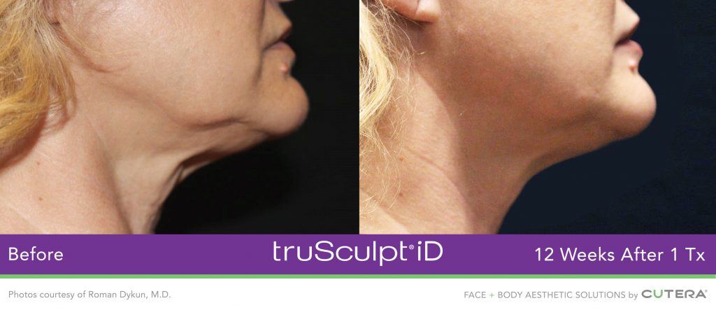 truSculpt® iD