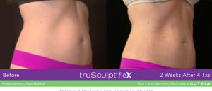 truSculpt® Flex