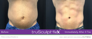 truSculpt® Flex