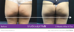 truSculpt® Flex